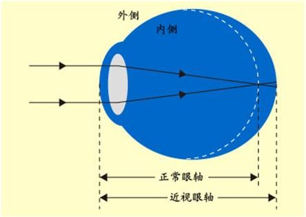 近视知识